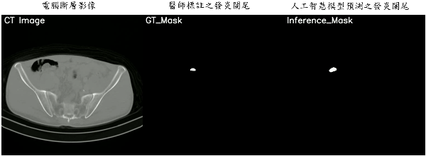 元智電機系攜手亞東影像醫學科團隊，使用電腦斷層掃描影像，進行判別是否發生急性闌尾炎